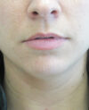 Dermal Fillers case #4304