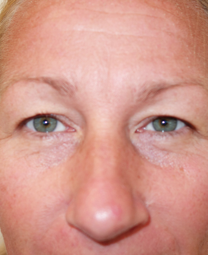 Eyelid Surgery case #4365