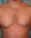 Gynecomastia case #4203