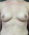 Breast Augmentation case #4010