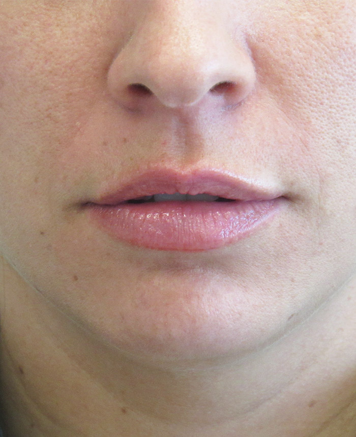 Dermal Fillers case #4304