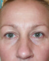 Eyelid Surgery case #4365