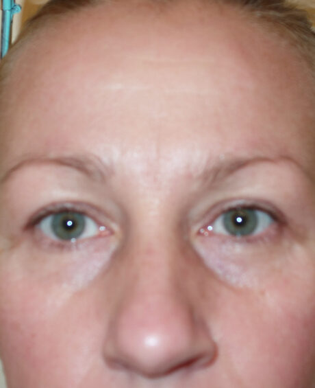 Eyelid Surgery case #4365