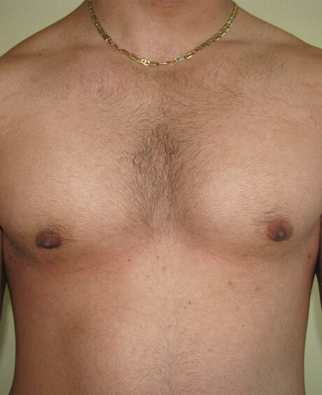 Gynecomastia case #4203