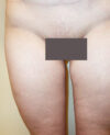 Thigh, Buttock, & Arm Lift case #4190