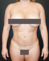 Liposuction case #4490