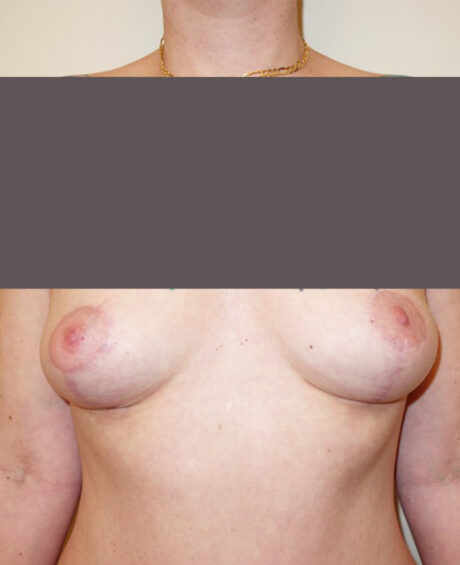 Breast Lift case #4544