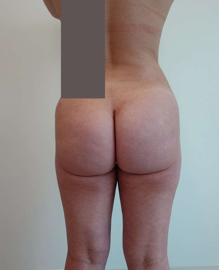 Brazilian Butt Lift case #4469