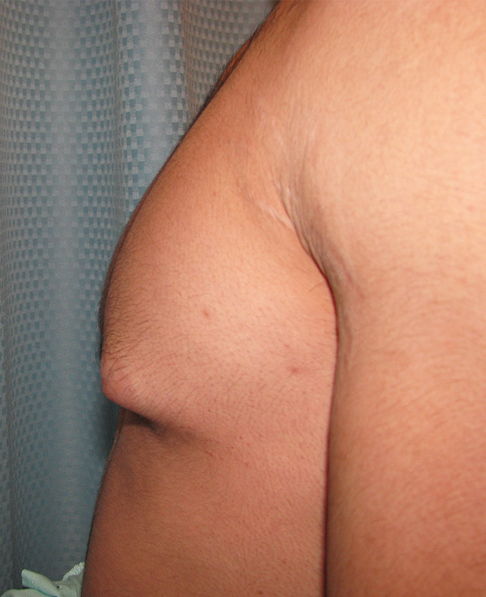 Gynecomastia case #4203