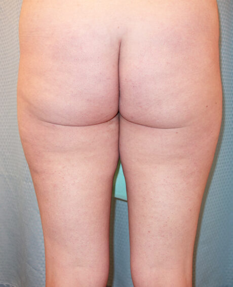 Thigh, Buttock, & Arm Lift case #4190