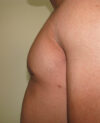 Gynecomastia case #4203