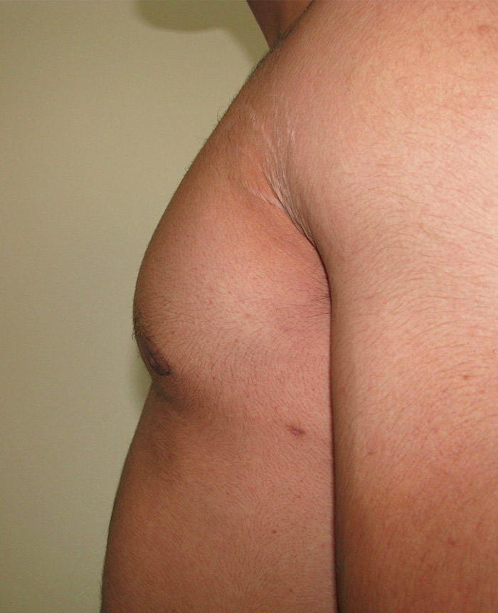 Gynecomastia case #4203