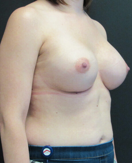 Breast Augmentation case #4010