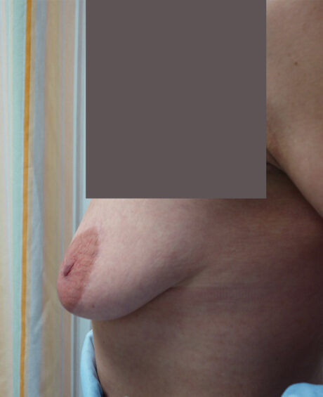 Breast Lift case #4544