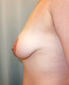 Breast Augmentation With Lift case #4570