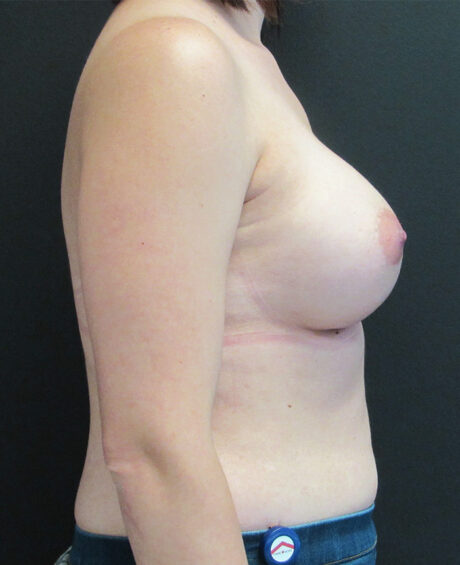 Breast Augmentation case #4010