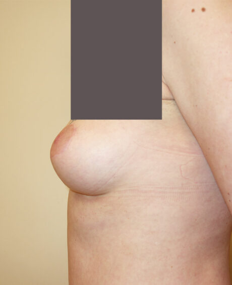Breast Lift case #4544