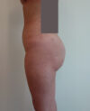 Brazilian Butt Lift case #4469