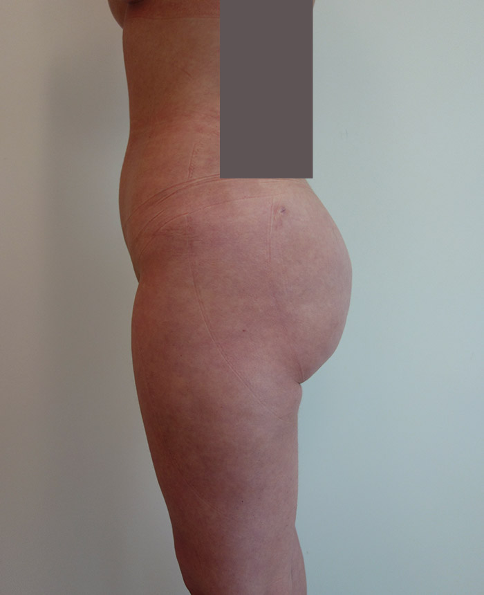 Brazilian Butt Lift