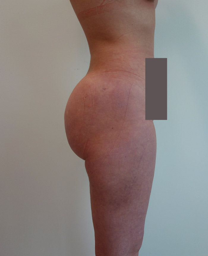 Brazilian Butt Lift