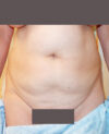 Liposuction case #4495