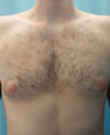 Gynecomastia case #4208