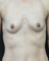 Breast Augmentation case #4036