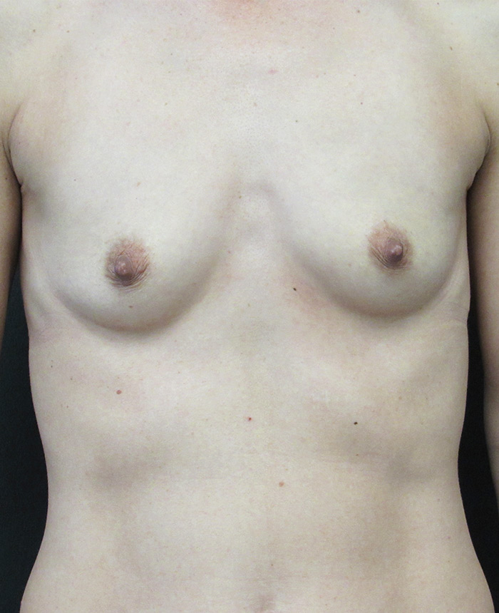 Breast Augmentation case #4036