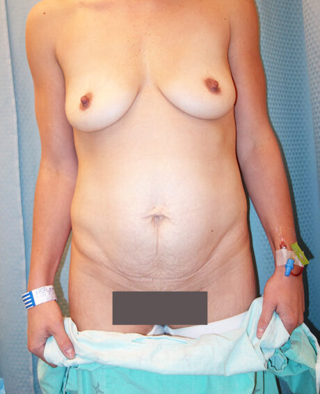 Tummy Tuck case #4089