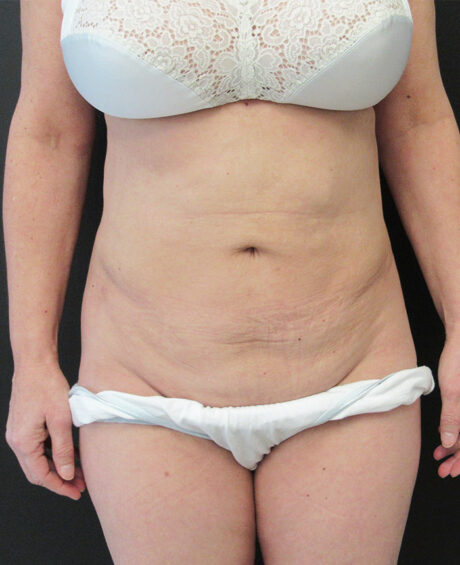 Liposuction case #4495