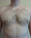 Gynecomastia case #4208