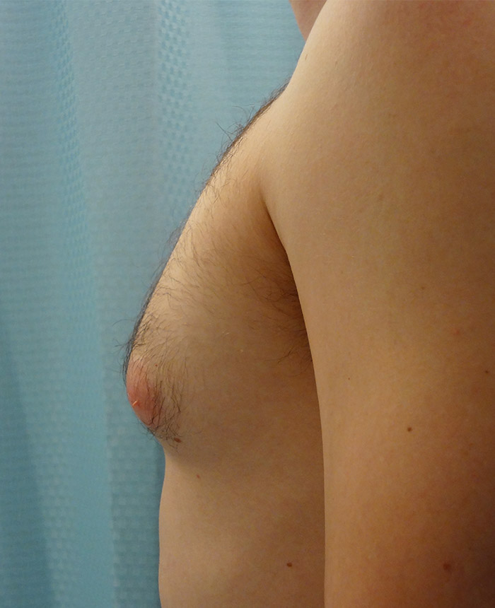 Gynecomastia case #4208