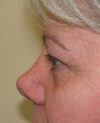 Eyelid Surgery case #4368