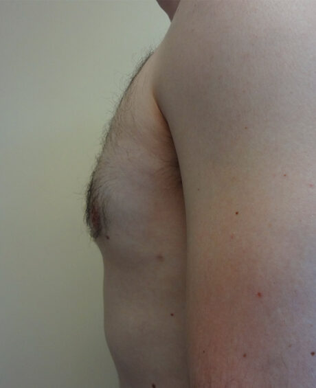 Gynecomastia case #4208