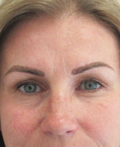 BOTOX® Cosmetic case #4257