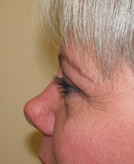 Eyelid Surgery case #4368