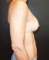 Breast Augmentation case #4036