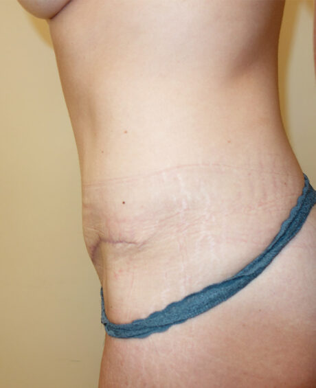 Tummy Tuck case #4089