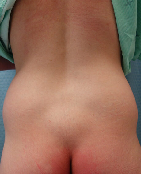 Liposuction case #4498