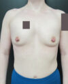 Breast Augmentation case #4043