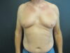 Gynecomastia case #4213