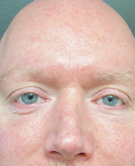 Eyelid Surgery case #4373