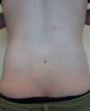 Liposuction case #4498