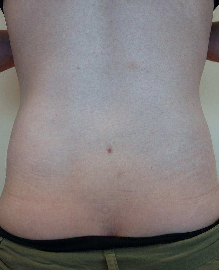 Liposuction case #4498