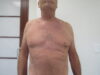 Gynecomastia case #4213