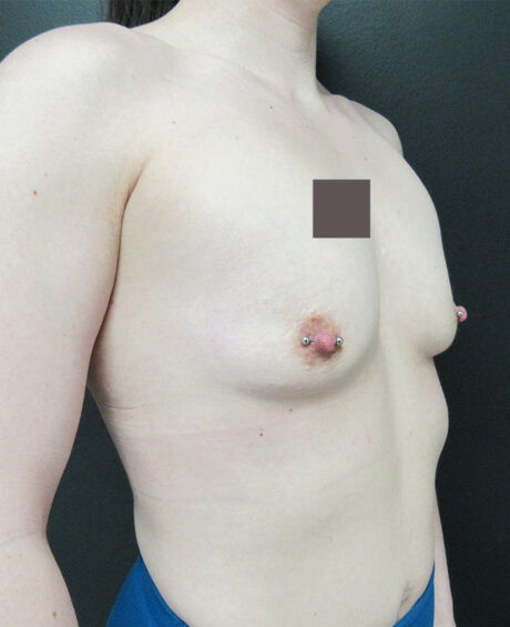 Breast Augmentation case #4043