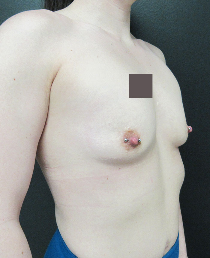 Breast Augmentation