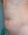 Tummy Tuck case #4096