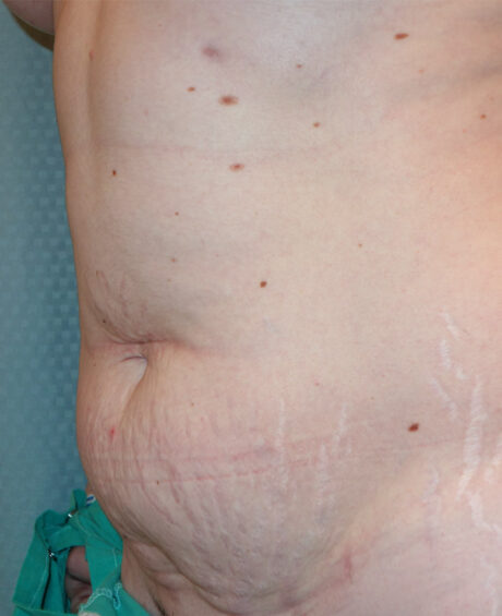 Tummy Tuck case #4096