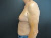 Gynecomastia case #4213